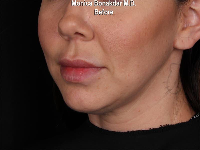 Dramatic Lip Enhancement Before & After Photo