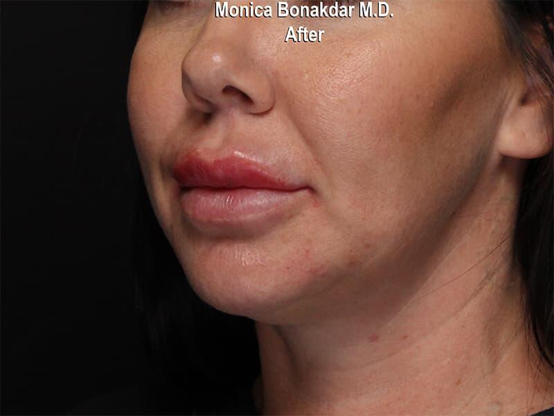 Injectable Treatments Before & After Photo