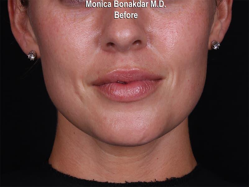 Dramatic Lip Enhancement Before & After Photo