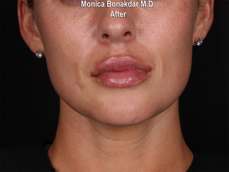 Dramatic Lip Enhancement Before & After Photo