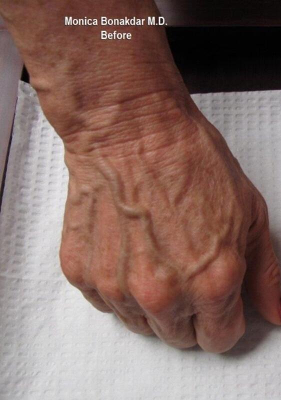 Hand Rejuvenation Before & After Photo