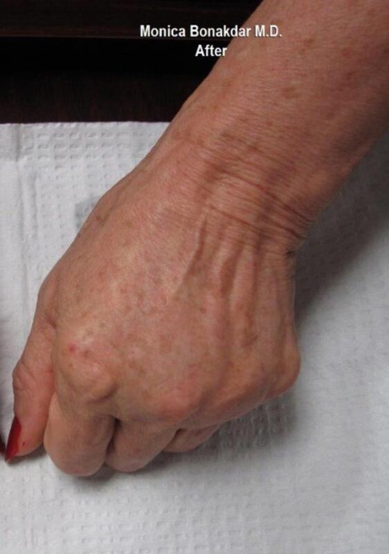 Hand Rejuvenation Before & After Photo