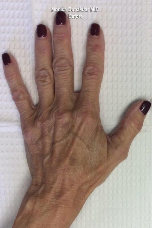 Hand Rejuvenation Before & After Photo