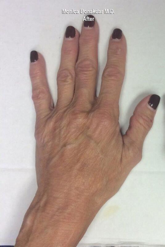 Hand Rejuvenation Before & After Photo