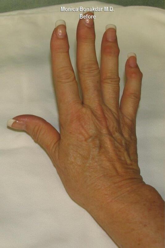 Hand Rejuvenation Before & After Photo