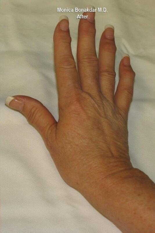 Hand Rejuvenation Before & After Photo