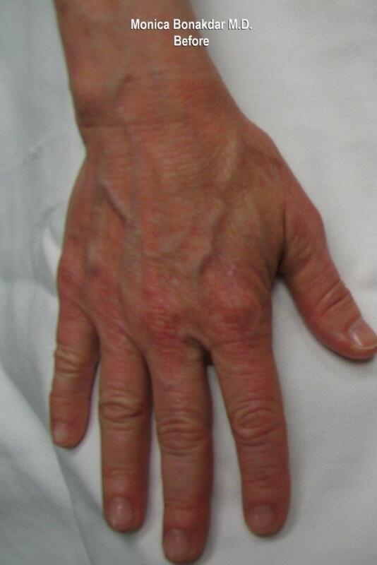 Hand Rejuvenation Before & After Photo