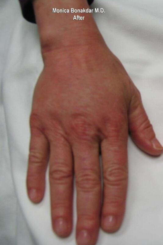 Hand Rejuvenation Before & After Photo