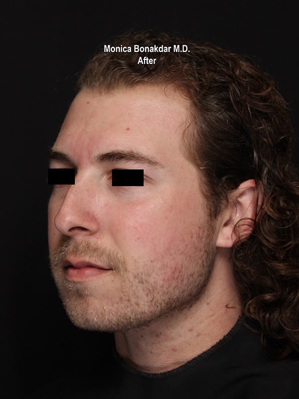 Lower Face and Jaw Contour Before & After Photo