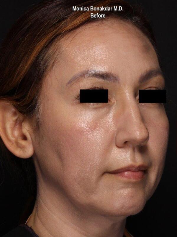 Lower Face and Jaw Contour Before & After Photo