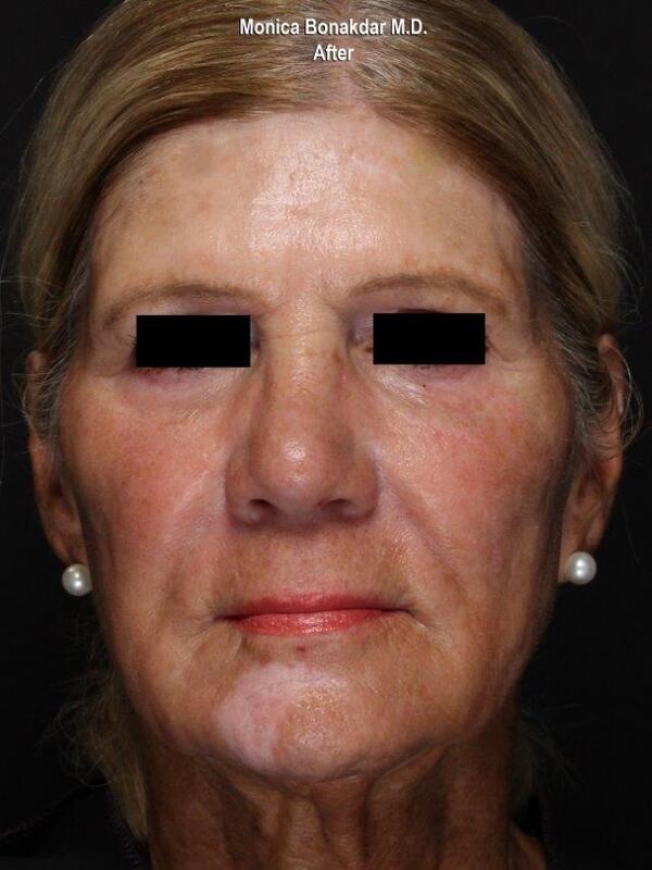 Lower Face and Jaw Contour Before & After Photo