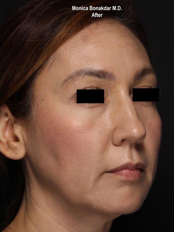 Lower Face and Jaw Contour Before & After Photo