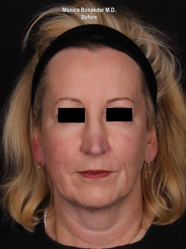 Lower Face and Jaw Contour Before & After Photo