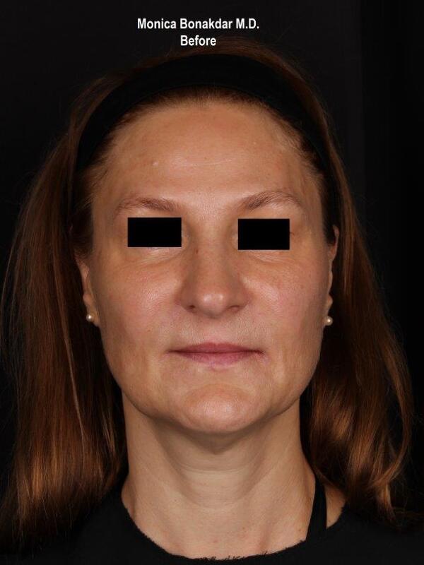 Lower Face and Jaw Contour Before & After Photo