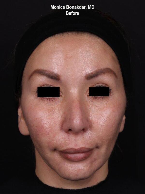 Lower Face and Jaw Contour Before & After Photo