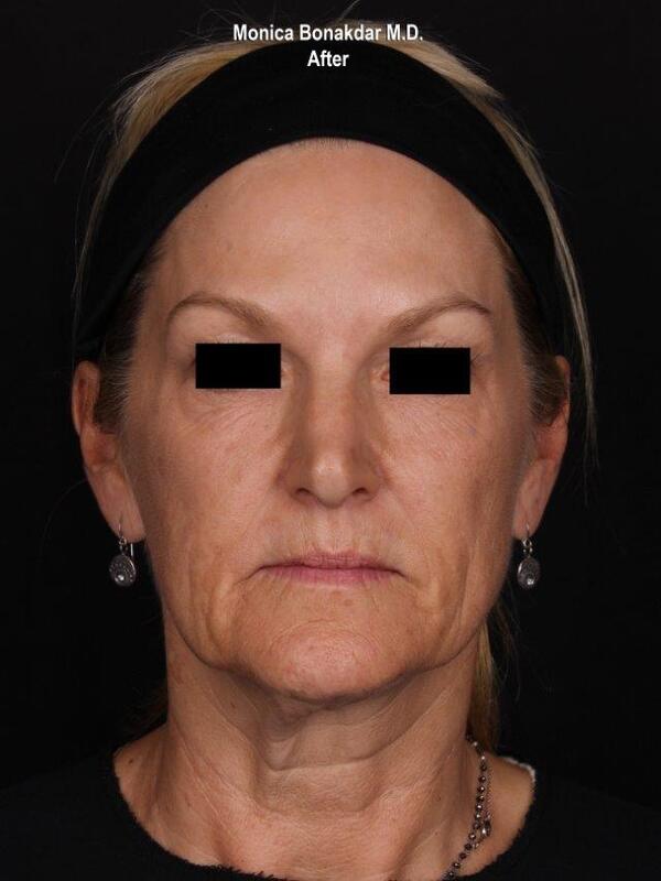 Lower Face and Jaw Contour Before & After Photo