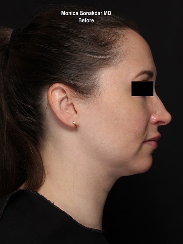 Kybella Before & After Photo