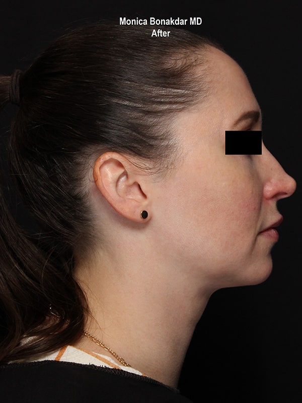 Kybella Before & After Photo