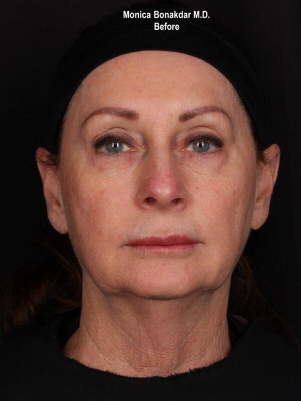 Kybella Before & After Photo