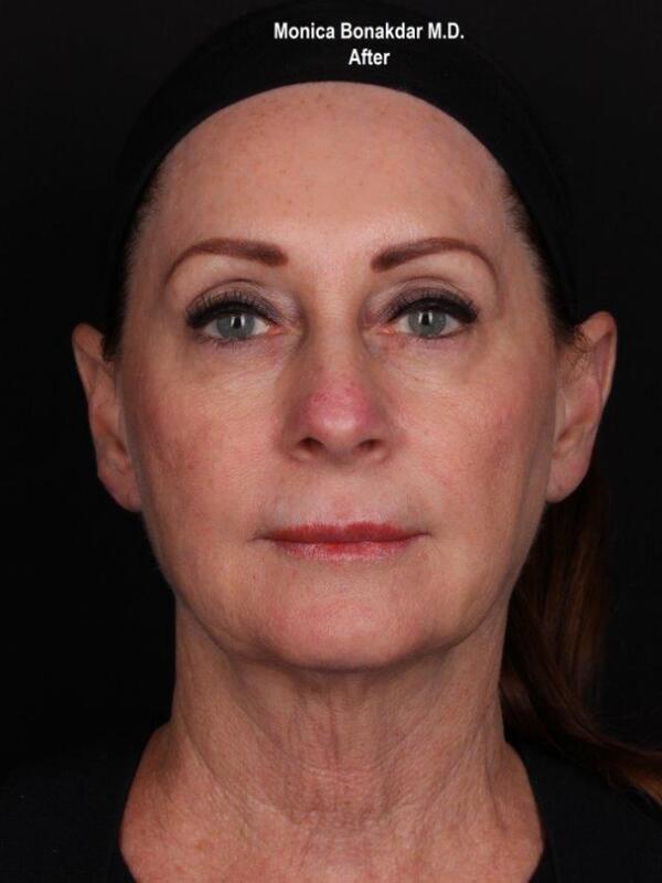 Kybella Before & After Photo