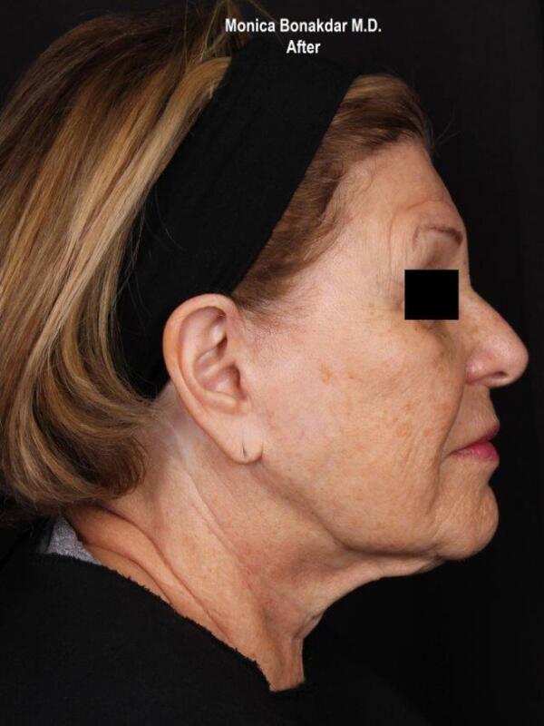 Kybella Before & After Photo