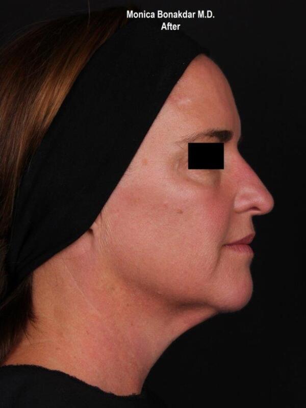 Kybella Before & After Photo