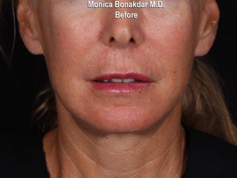 Lips: Lip Line Correction Before & After Photo