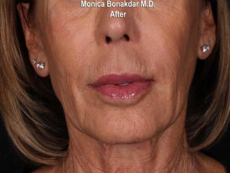 Lips: Lip Line Correction Before & After Photo