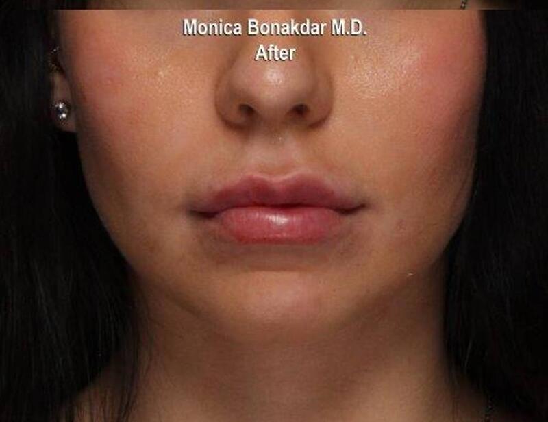 Lips: Moderate Lip Enhancement Before & After Photo