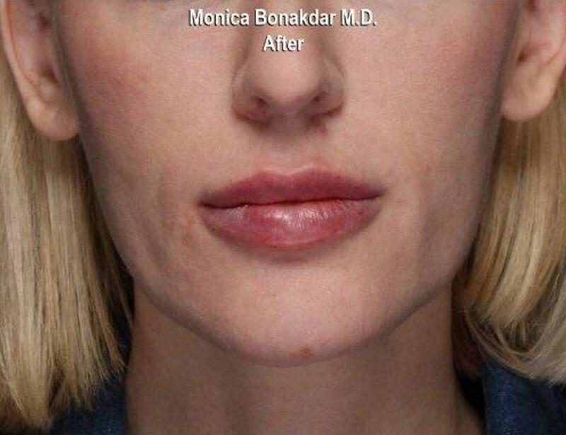 Lips: Moderate Lip Enhancement Before & After Photo