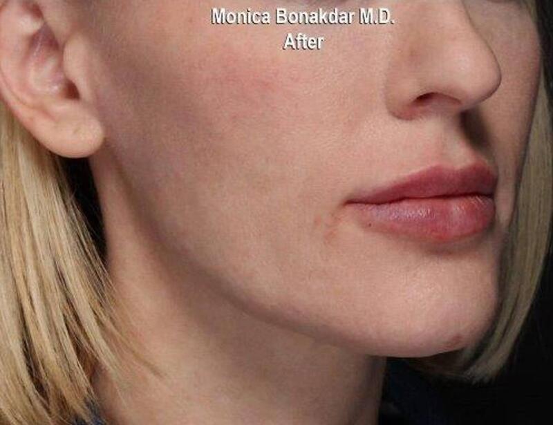 Lips: Moderate Lip Enhancement Before & After Photo
