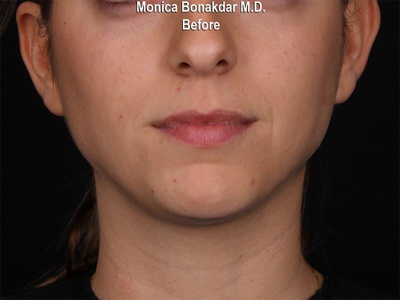 Lips: Moderate Lip Enhancement Before & After Photo