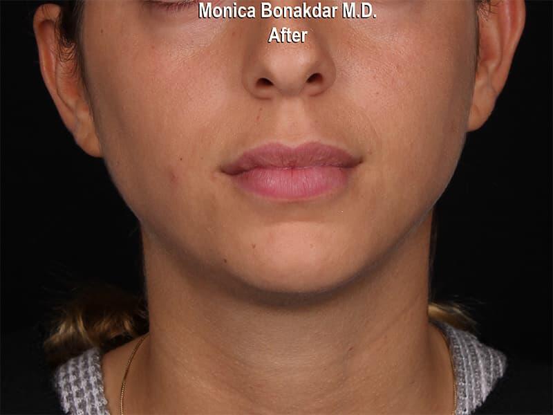 Lips: Moderate Lip Enhancement Before & After Photo