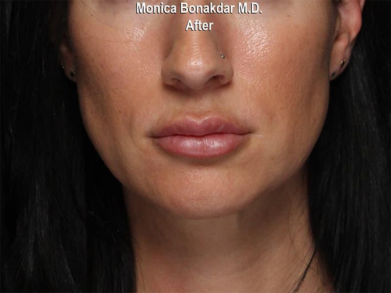 Lips: Moderate Lip Enhancement Before & After Photo