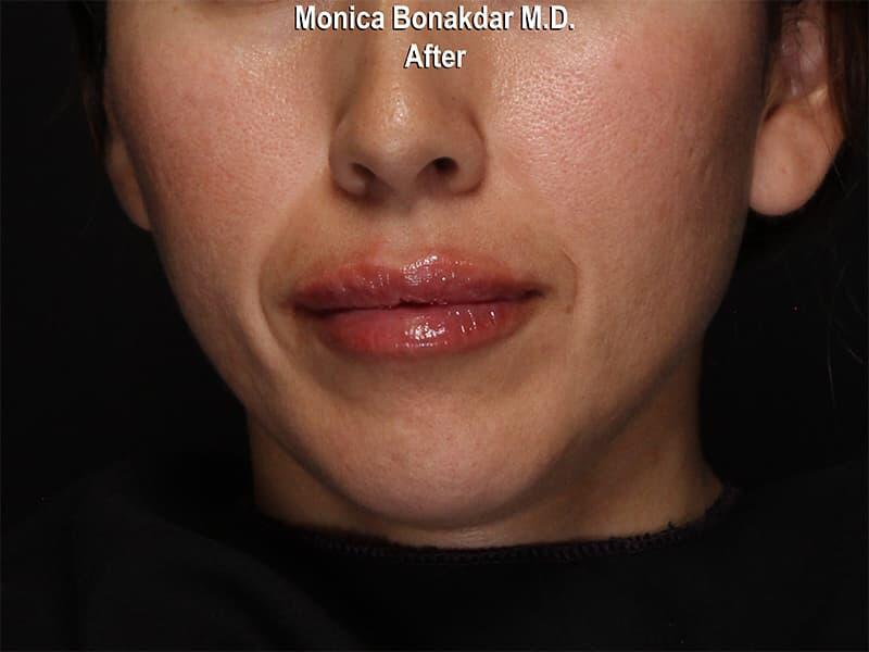 Lips: Moderate Lip Enhancement Before & After Photo