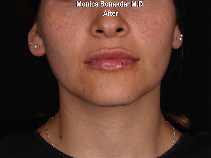 Lips: Moderate Lip Enhancement Before & After Photo