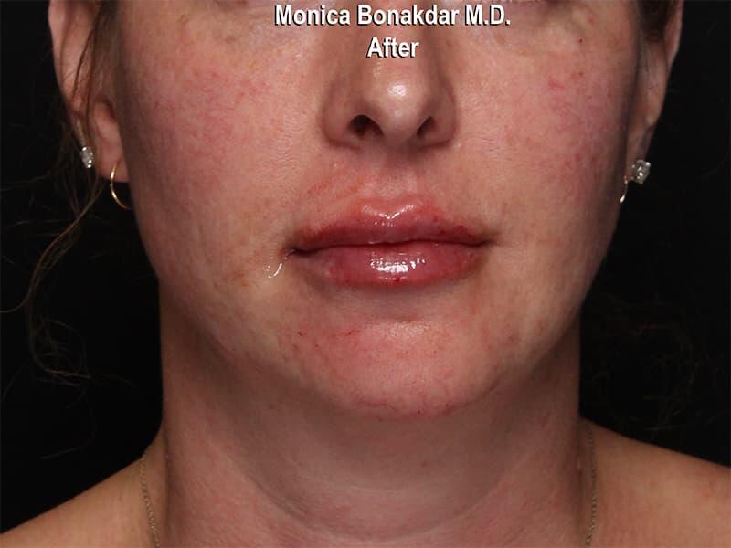 Lips: Moderate Lip Enhancement Before & After Photo