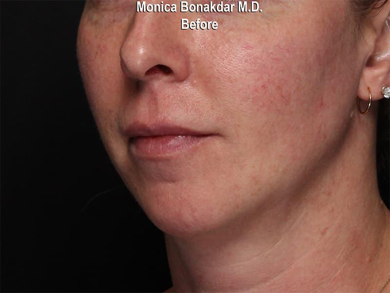 Moderate Lip Enhancement Before & After Photo