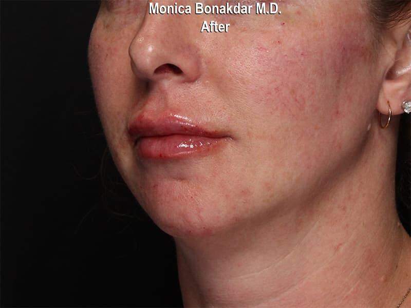 Moderate Lip Enhancement Before & After Photo