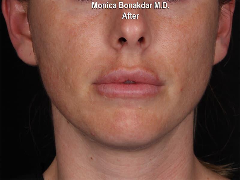 Lips: Moderate Lip Enhancement Before & After Photo