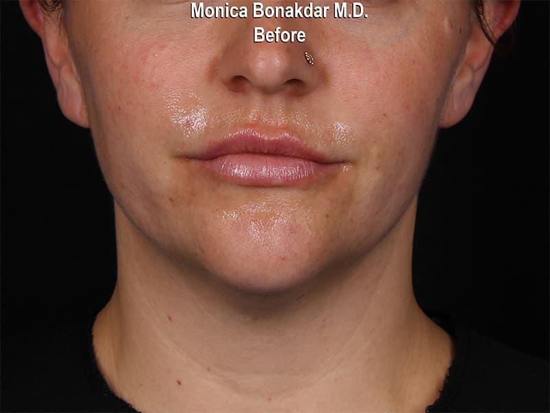 Lips: Moderate Lip Enhancement Before & After Photo