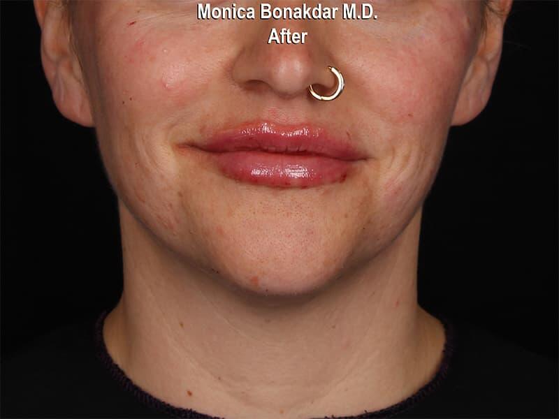 Lips: Moderate Lip Enhancement Before & After Photo