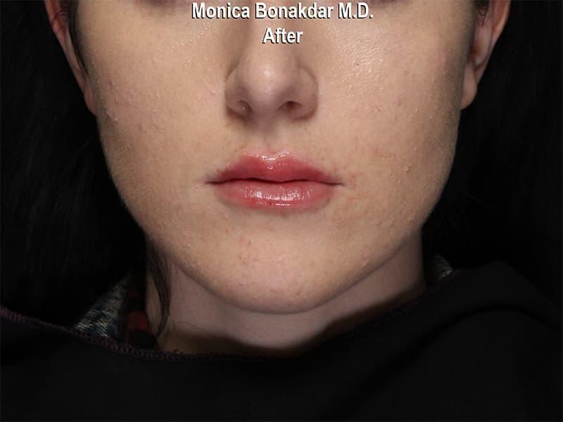 Lips: Moderate Lip Enhancement Before & After Photo