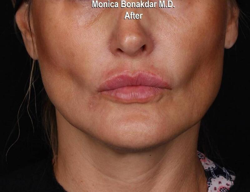 Lips: Moderate Lip Enhancement Before & After Photo