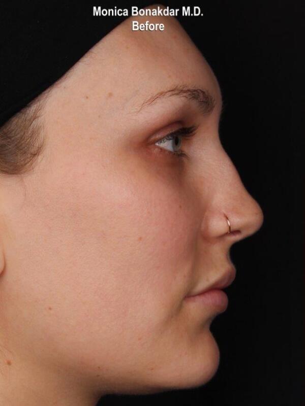 Nonsurgical Nose Job Before & After Photo