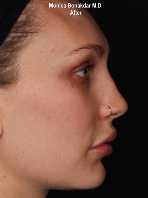 Nonsurgical Nose Job Before & After Photo