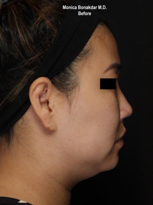 Nonsurgical Nose Job Before & After Photo