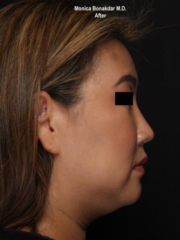 Nonsurgical Nose Job Before & After Photo