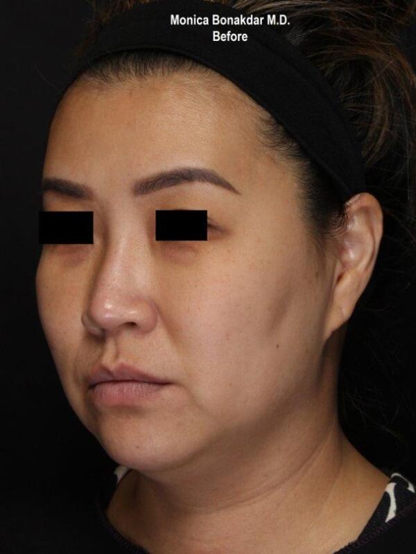 Nonsurgical Nose Job Before & After Photo