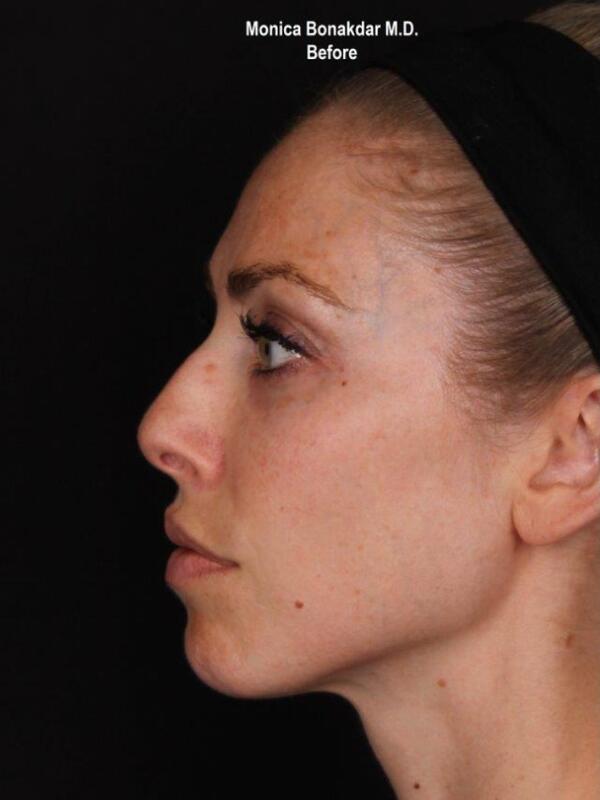 Nonsurgical Nose Job Before & After Photo